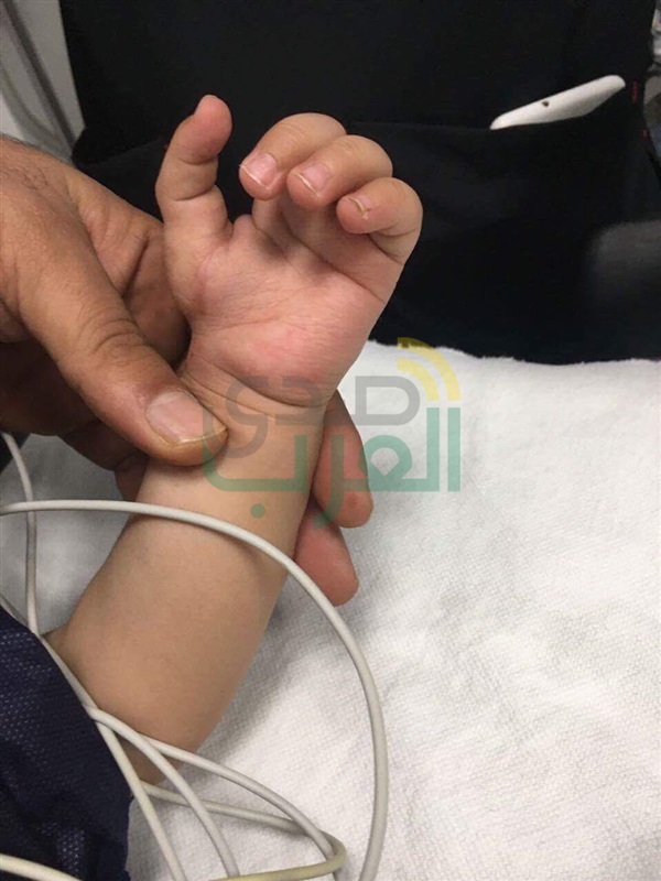 بالصور.. خبير مصري ألماني يعيد بناء "الإبهام" لطفل خلق بأربعة أصابع