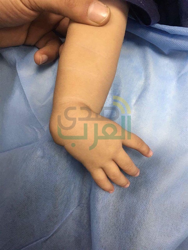 بالصور.. خبير مصري ألماني يعيد بناء "الإبهام" لطفل خلق بأربعة أصابع