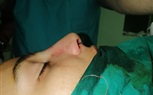 صحة الشرقية: إجراء ١١ عملية تجميل بمركز ههيا للحروق منهم تجميل الأنف للمرة الأولي