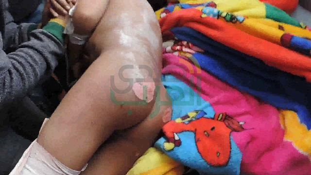 بالصور.. أم وزوجها تعذب طفل بحرق كامل جسده بالخانكة