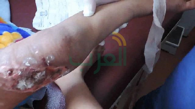 بالصور.. أم وزوجها تعذب طفل بحرق كامل جسده بالخانكة