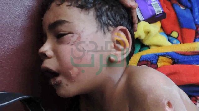 بالصور.. أم وزوجها تعذب طفل بحرق كامل جسده بالخانكة