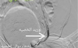 مستشفى سوهاج الجامعي تجري أول قسطرة علاجية لعلاج دوالي الخصية بدون جراحة