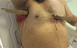 بالصور.. إنقاذ حياة شخص اخترقت «خشبة» صدره في كفر الشيخ 