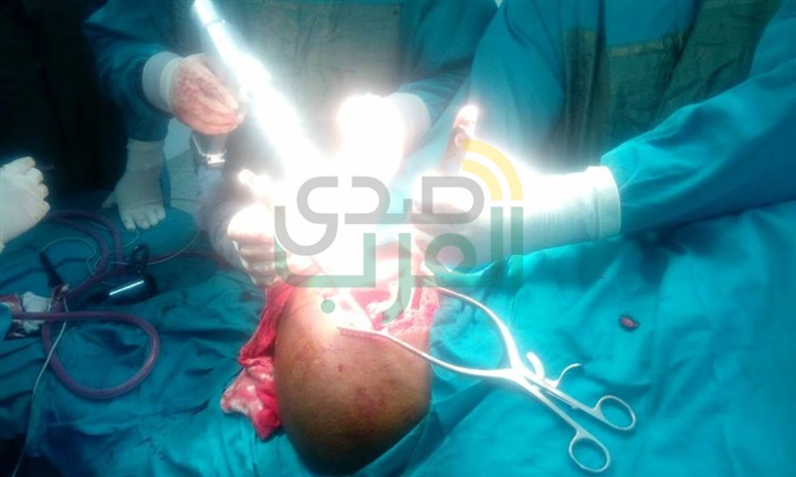 بالصور.. أول عملية تغيير مفصل بمستشفى عام بالبحر الأحمر