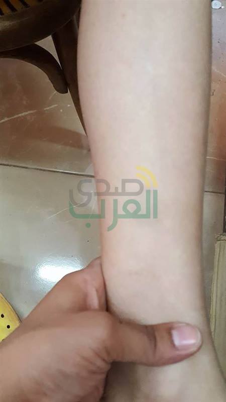 بالصور.. اعتداء معلمتين بمدرسة في الحامول بكفر الشيخ على طالب بـ"خيرزانة"