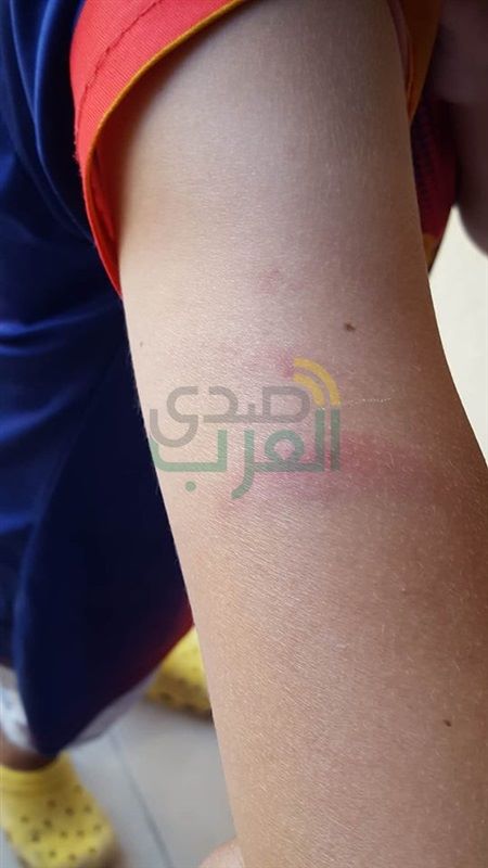 بالصور.. اعتداء معلمتين بمدرسة في الحامول بكفر الشيخ على طالب بـ"خيرزانة"