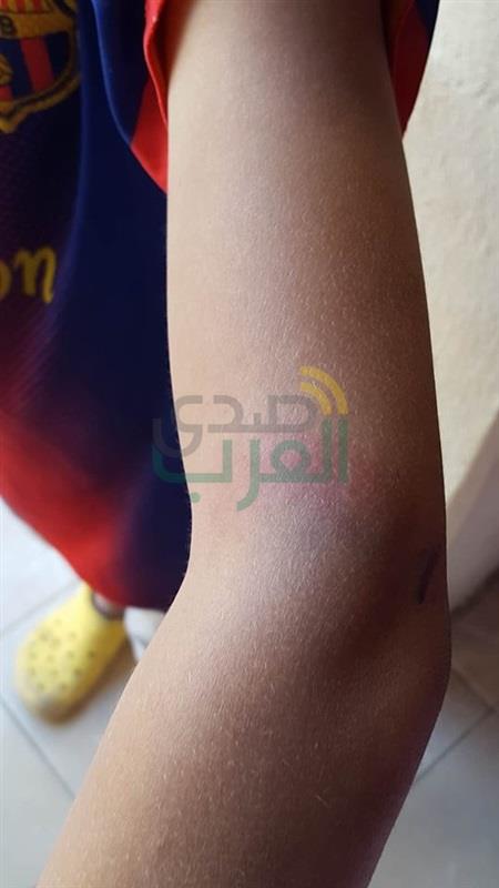 بالصور.. اعتداء معلمتين بمدرسة في الحامول بكفر الشيخ على طالب بـ"خيرزانة"