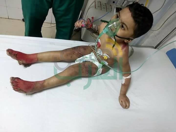 بالصور.. عودة الابتسامة لوجه الطفل "يحيي" ضحية التعذيب علي يد والدته وزوجها بكفر الشيخ