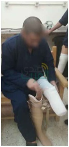 «السجون» توفر أطراف صناعية لـ41 نزيلا بـ«سجن المنيا»