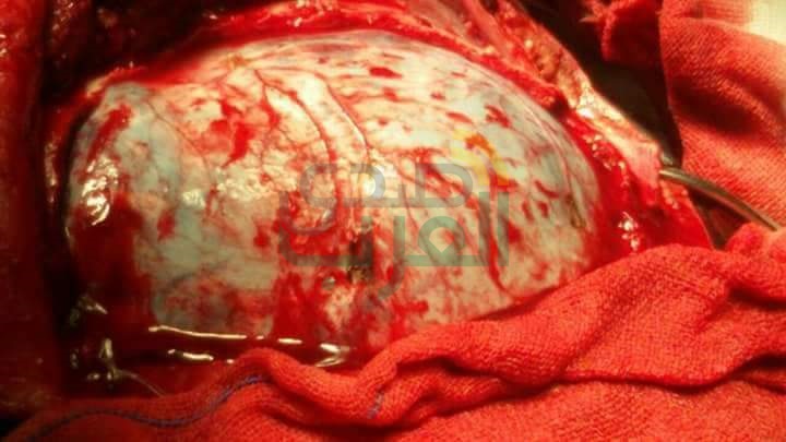 إجراء أول عملية جراحية بالمخ بمستشفى قليوب المركزي